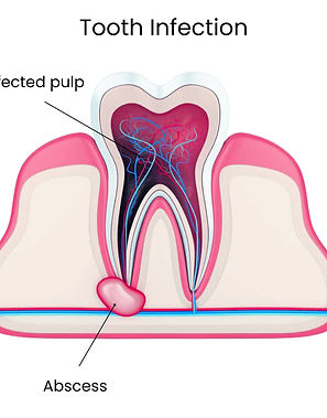 tooth-infection.jpg