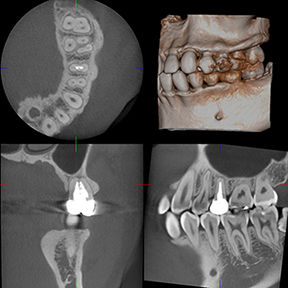 Thumbnail: 3D Accuitomo 170 Cone Beam CT System