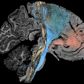 Drafting a ‘dysfunctome’: Faulty connections to subthalamic nucleus characterize disparate brain disorders