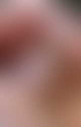 PRX-T33: A Painless, Effective Facial Treatment! This biorevitalizer helps bring back the skin's natural radiance by stimulating cell renewal and regeneration in the basal layer of the skin.