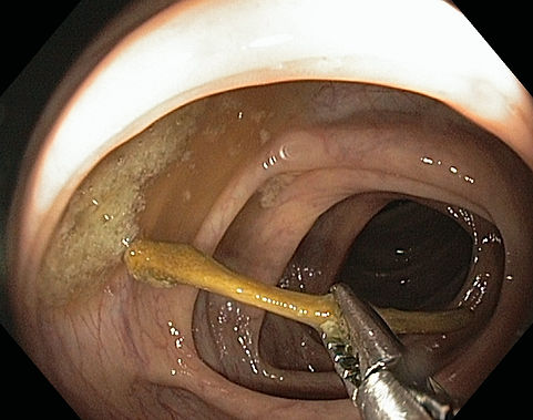 Retirada Corpo Estranho Íleo (osso)