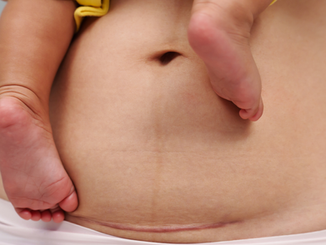 Cesáreas innecesarias: qué nos dice la evidencia reciente y qué implica para la práctica profesional