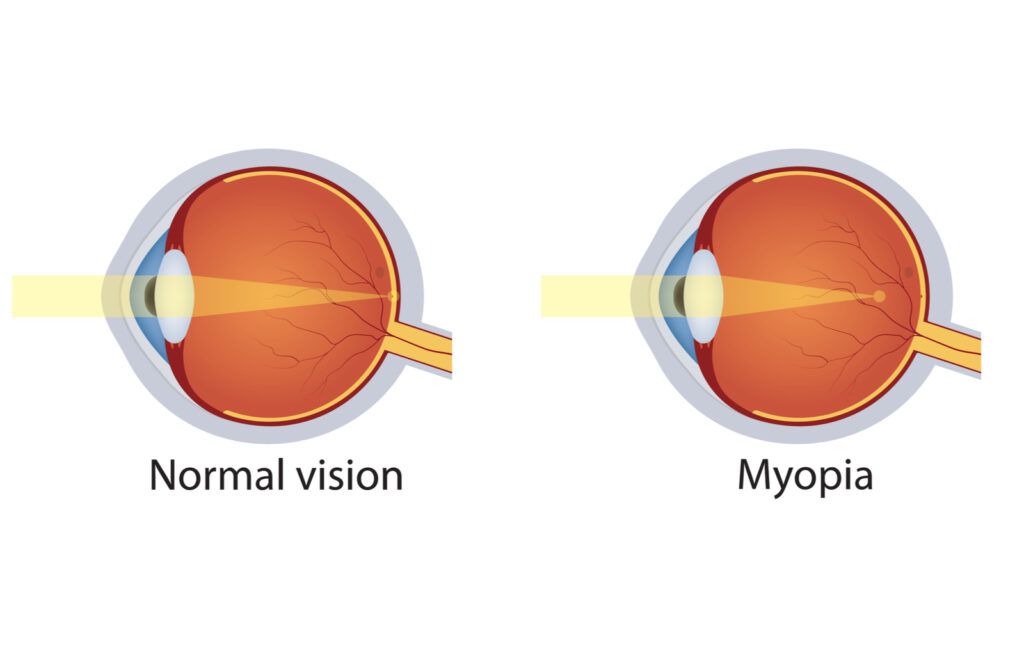 Myopia Eye Vision Problem