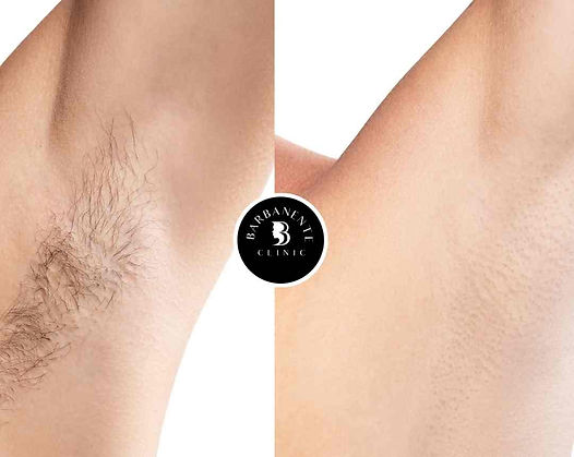 soprano-laser-hair-removal-london.jpg