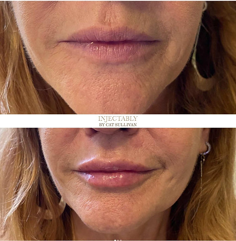lip-fillers-Cat-Sullivan-Harley-Street-London.jpg