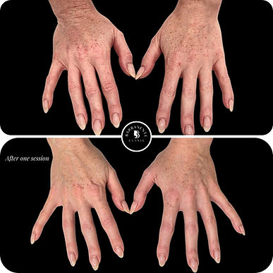 picosure pro laser before and after.jpg