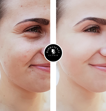 before and after facial mesotherapy treatment in London