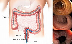 Colonoscopia-848x518.png