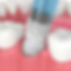 synteticbonegraft.png