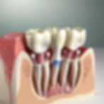 create pictures _Allograft_ Bone is sourced from a human donor. It’s carefully processed