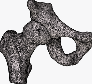 hip impingement FAI femoroacetabular impingement labral tear, hip arthroscopy