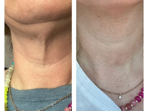 RF Microneedling: Elevated Skin Renewal Experience