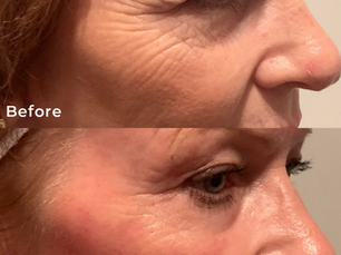 CO2 Laser Resurfacing