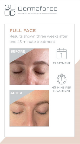 Full face 3D Dermaforce microneedling