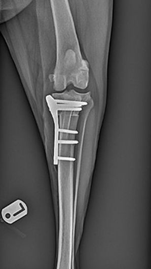 X-ray of a leg bone with surgical plate and screws