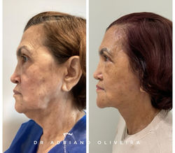 Cervicoplastia Tratamento de todo o terço inferior da face Flacidez em papada, pescoço e f