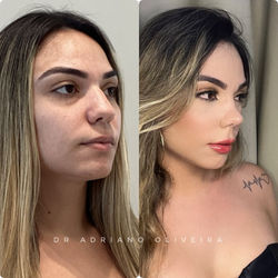 Quando a Priscila me procurou ela gostaria de deixar o seu rosto mais delicado e que o nar