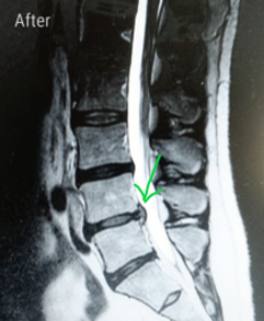 MRI after spinal decompression therapy disc herniation bulging
