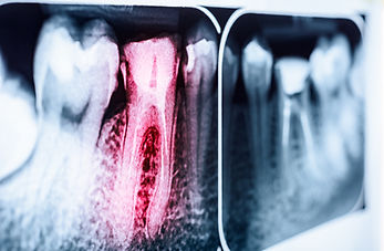 RootDecay_1200x801.jpeg