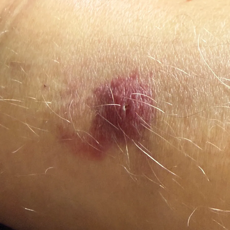 Close-up of a horsefly bite on a golfer's leg, 48 hours after being bitten on the Valley Course at Greetham Valley Golf Club, Rutland, in mid-March 2026. The bite shows a dark raised centre with significant surrounding inflammation and bruising.