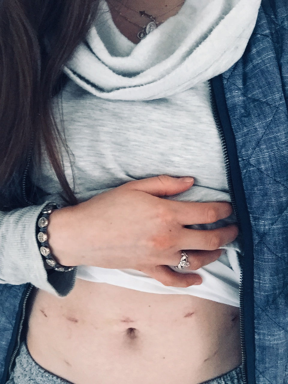 Woman holding abdomen post-surgical NaProTECHNOLOGY laparoscopy