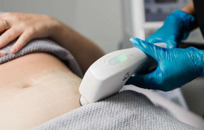Best Treatment for Stretch Marks in Kochi