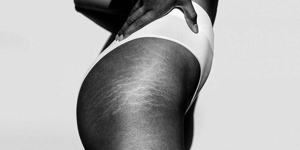 stretch-marks-2-1-1644938618.png