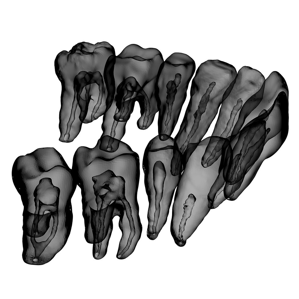 Thumbnail: Dentoform (Maxillary)