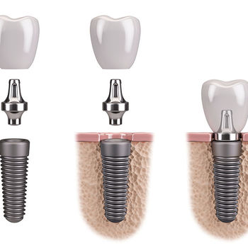 Implantes dentales 2.jpeg