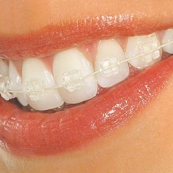 Brackets ceramicos. Dr 360