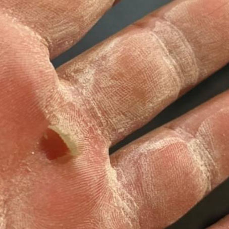 Calluses From the Rowing Machine?