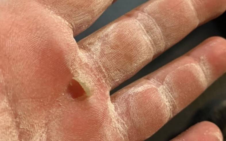 close up image of hand with callus that's open under finger
