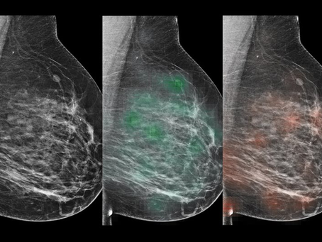 The Role of Genetic Testing in Identifying Breast Cancer Patients for Immunotherapy