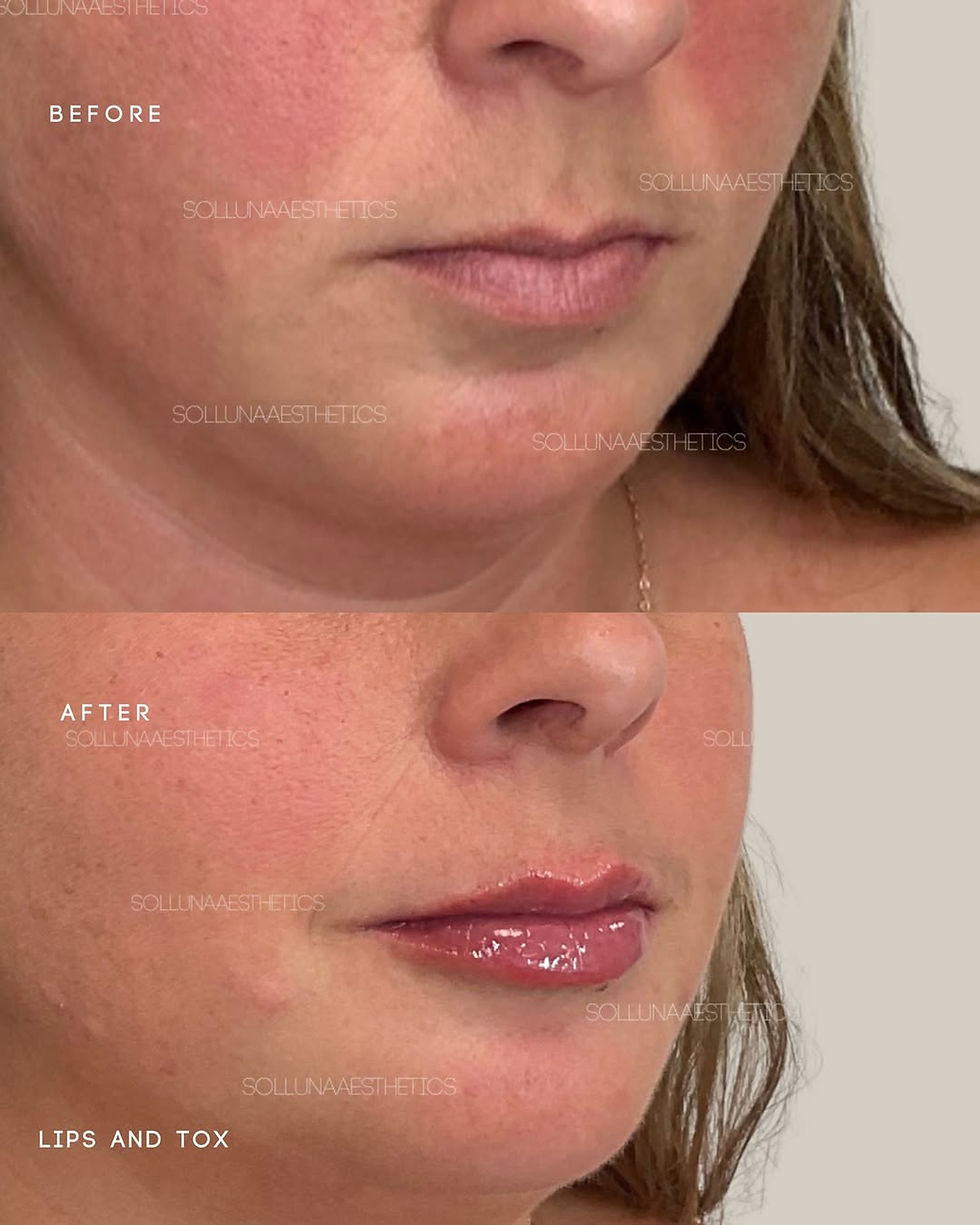 Dermal Fillers