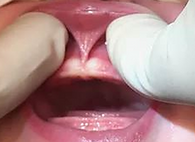Editie tongue tie image_edited_edited.pn