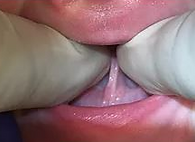 Editie tongue tie image_edited_edited.pn