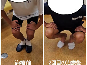 オスグットシュラッター病