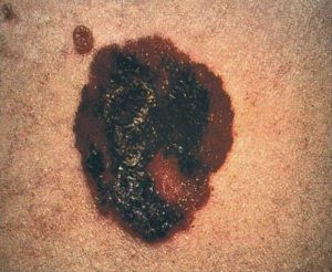 A skin cancer lesion that has varied colors throughout.