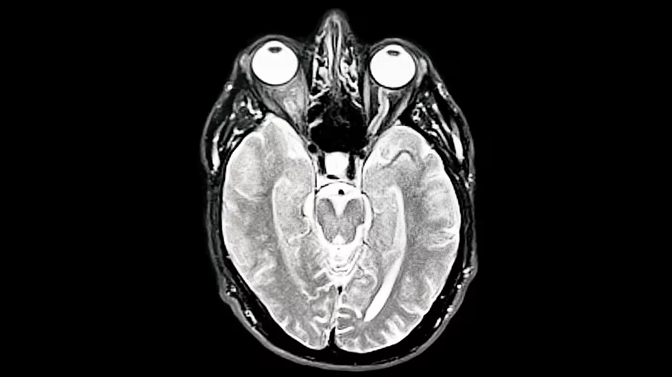 $1Million Awaits for AI Developer for Alzheimer's Treatment