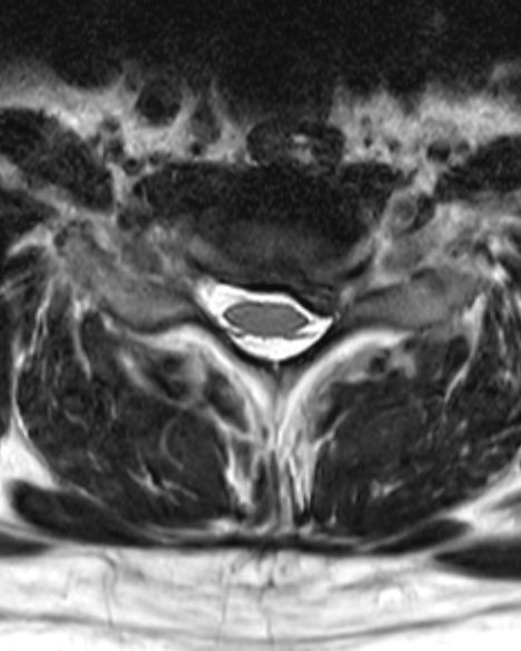 nekhernia axial_edited.jpg