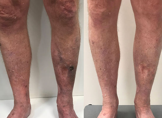 case-study-venous-ulcer-blogheader.jpg