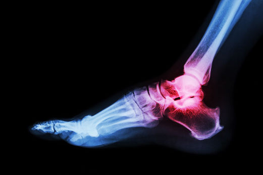 arthritis-ankle-film-x-ray-ankle-lateral-view-show-inflammed-ankle-joint.jpg