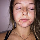 Girl with eyes closed lying down with acne on her face. 