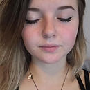 Girl with eyes closed and clear acne after treatment