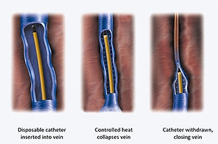 Varicose Veins Treatment