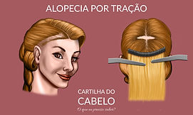 Alopecia por tração (Mega Hair)