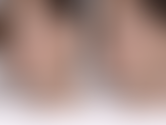 cheek filler before after natural results