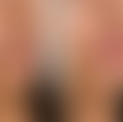 lip filler before and after natural results