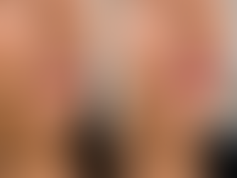 lip filler before and after natural results