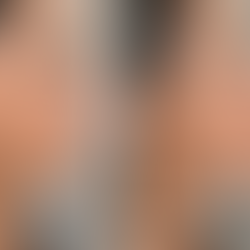 chin filler before and after profile improvement